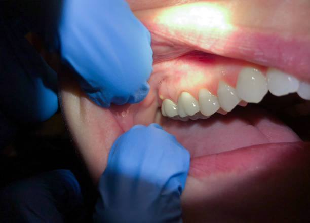 Best Emergency Treatment for Dental Infections or Abscesses in Benld, IL